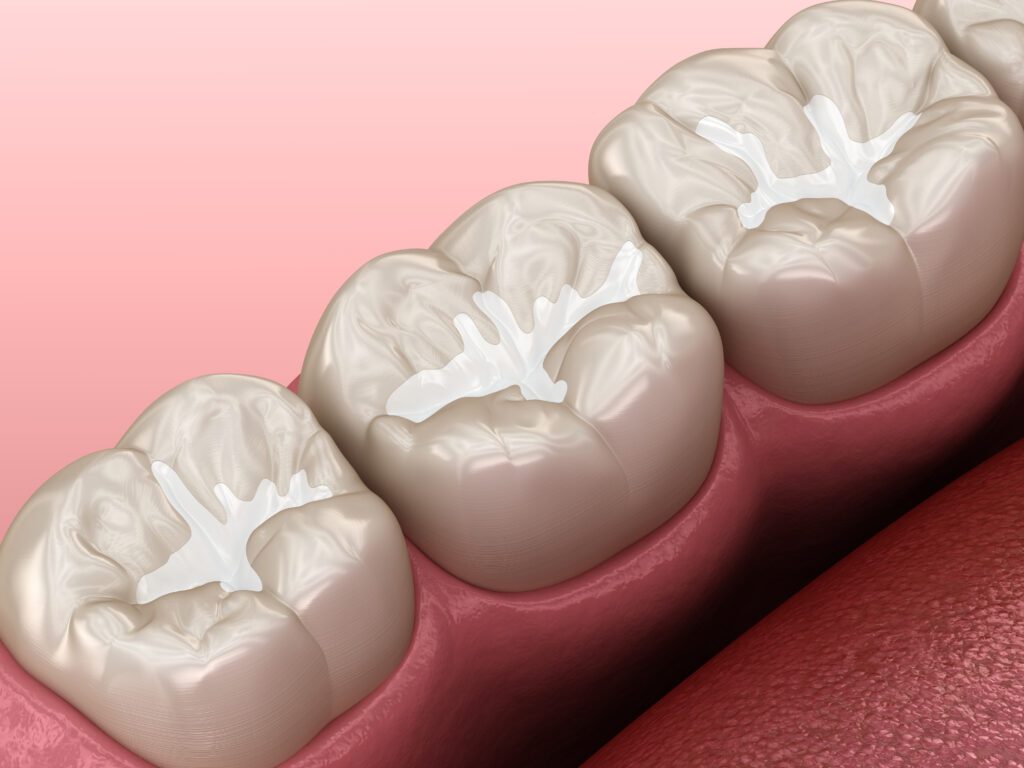 children's dental sealants